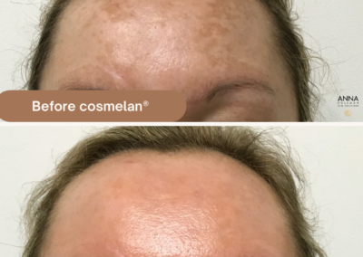 Before and After forehead Cosmelan